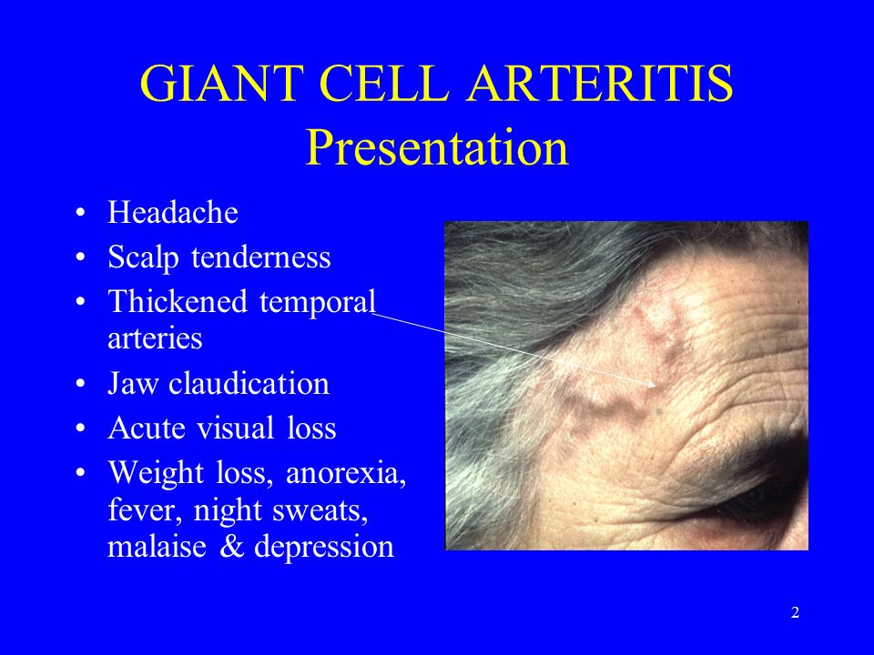 Giant cell arteritis prognosis